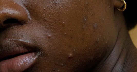 Why Real African Black Soap works for Hyperpigmentation: The Complete Guide